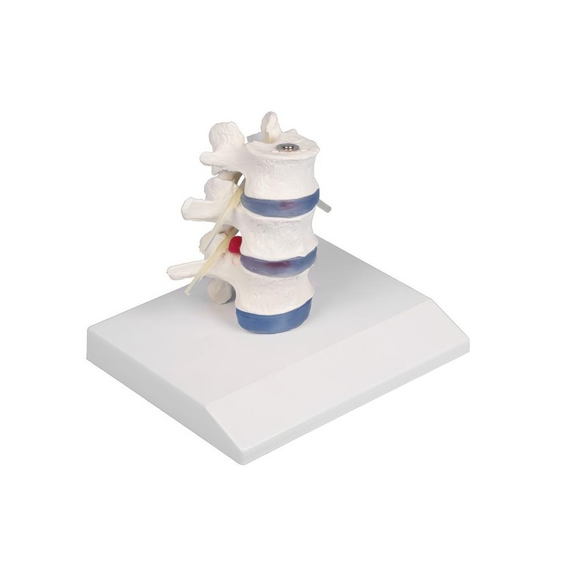 VERTEBRES LOMBAIRES DEMONTABLES AVEC HERNIE VERTEBRES LOMBAIRES DEMONTABLES AVEC HERNIE